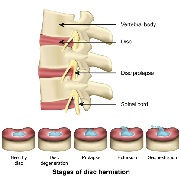 Etapas Hernia Discal Columna Vertebral Anatomía Discal Vector Médico Ilustración — Archivo Imágenes Vectoriales