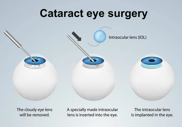 Catarata Cirugía Ocular Anatomía Vector Ilustración Con Descripción Inglés — Vector de stock