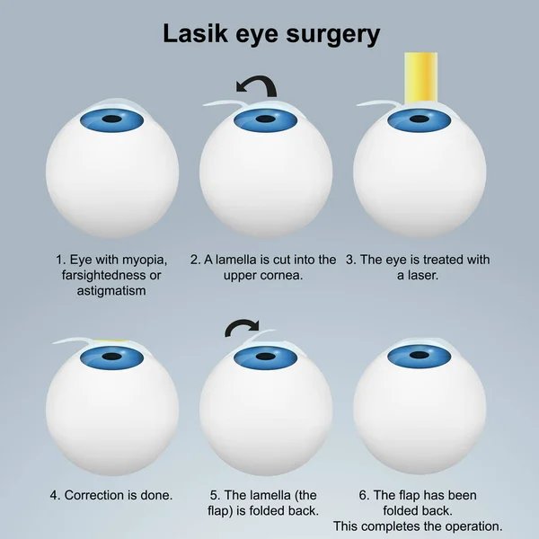 Lasik Cirugía Ocular Vector Médico Ilustración Con Descripción Inglés Eps — Vector de stock