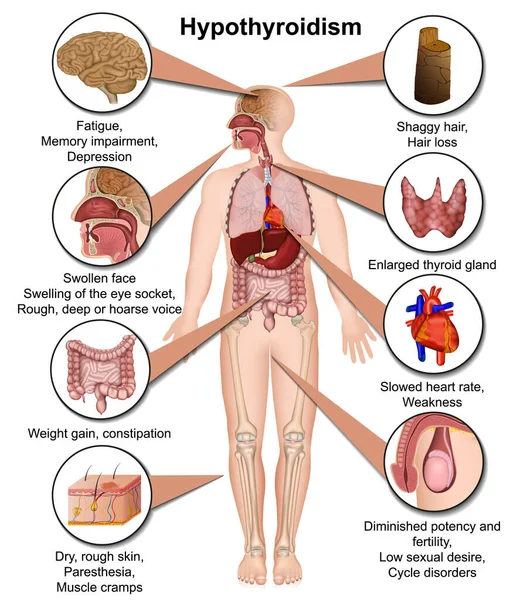 Ilustração Vetor Médico Hipotireoidismo Isolado Fundo Branco Infográfico Eps —  Vetores de Stock