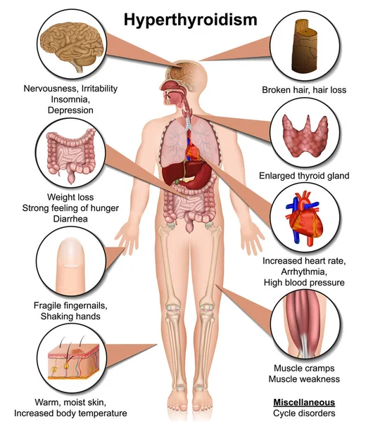 Hyperthyroidism Medical Vector Illustration Isolated White Background Infographic Eps — Stock Vector
