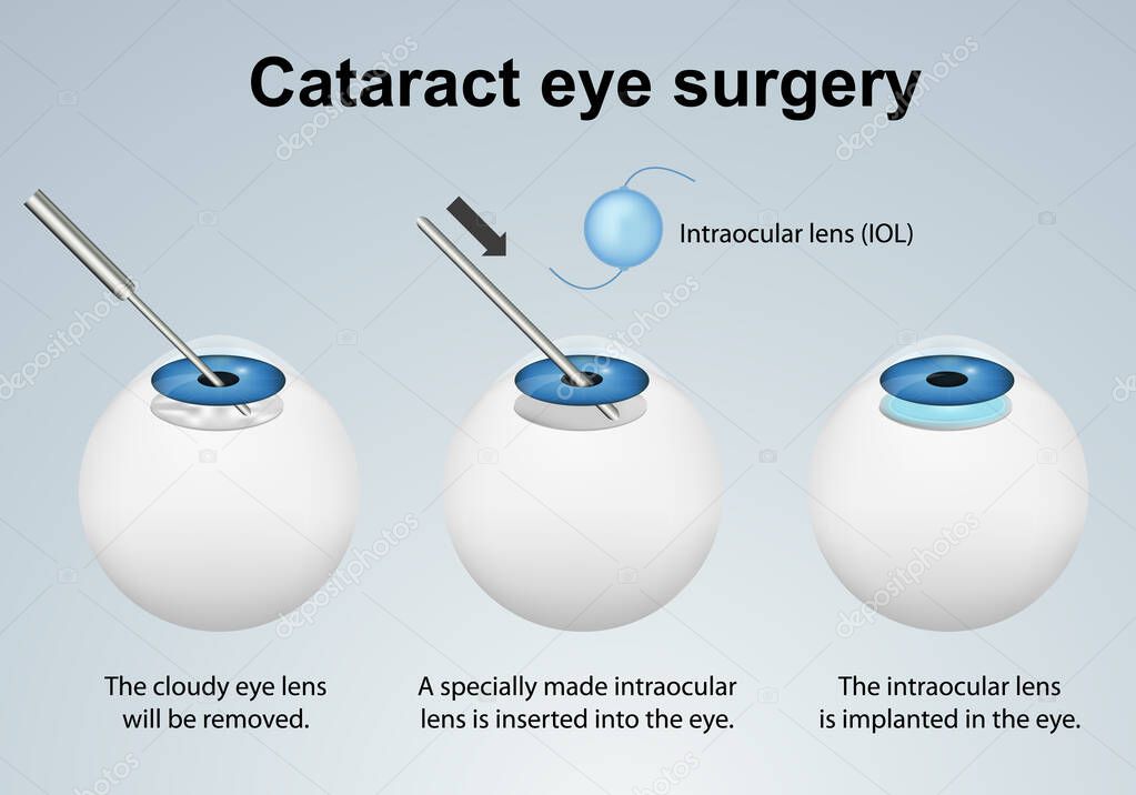 cataract eye surgery anatomy vector illustration with english description
