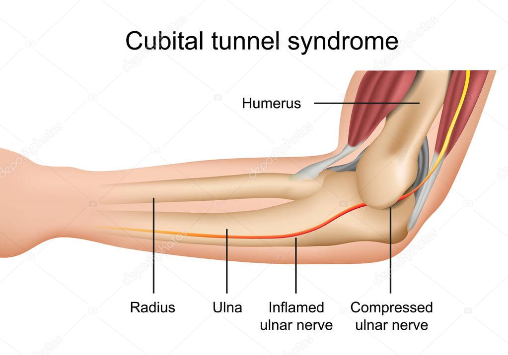 cubital tunnel syndrome medical vector illustration with english description