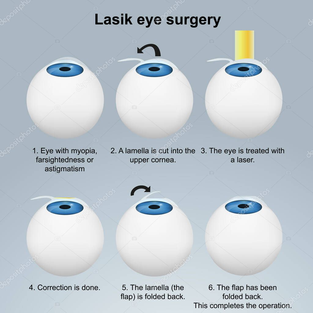 Lasik eye surgery medical vector illustration with english description eps 10