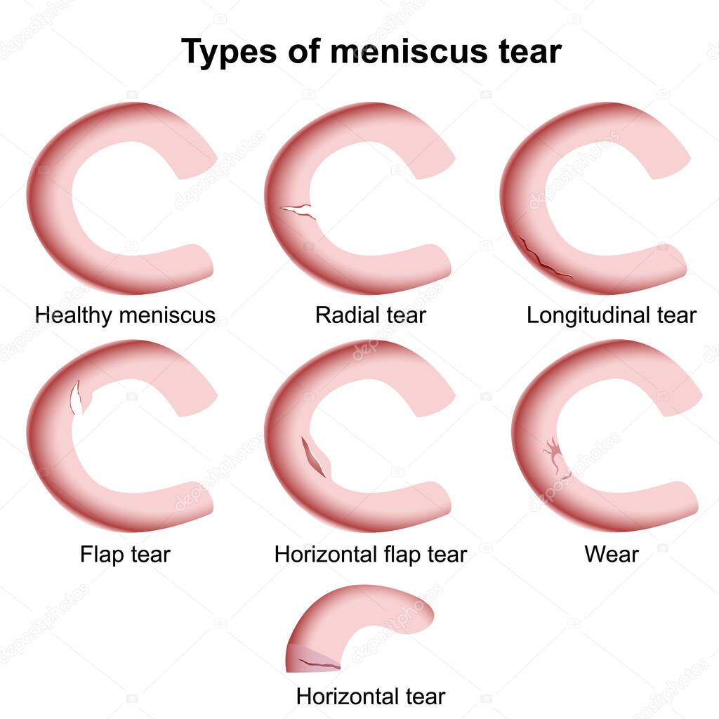 types of meniscus injuries medical vector illustration