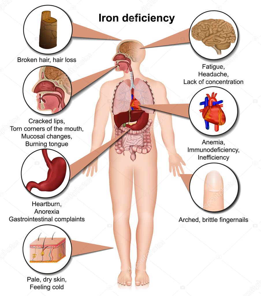 Iron deficiency effects on the body 3d medical vector illustration isolated on white background eps 10 infographic