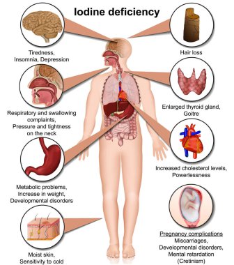 Beyaz arkaplanda izole edilmiş iyot eksikliği 3 boyutlu tıbbi vektör çizimi 10 bilgi verir