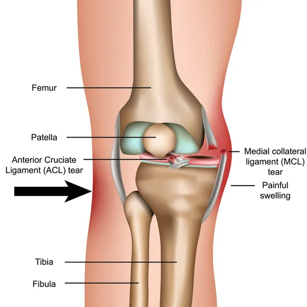脱臼膝 内側の担保靭帯涙医療ベクトル図白の背景に隔離 — ストックベクタ