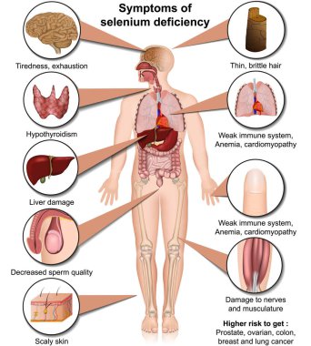 selenyum eksikliği tıbbi vektör çizimi beyaz arkaplan bilgisine izole edildi