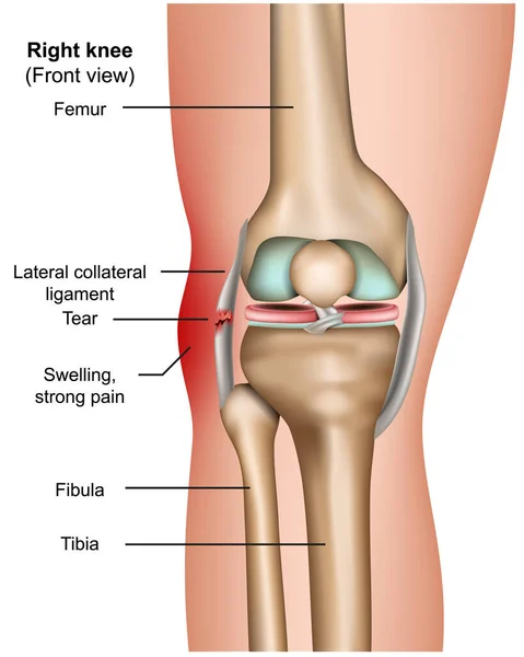 Lágrima Lateral Colateral Vector Médico Infografía Aislada Sobre Fondo Blanco — Vector de stock