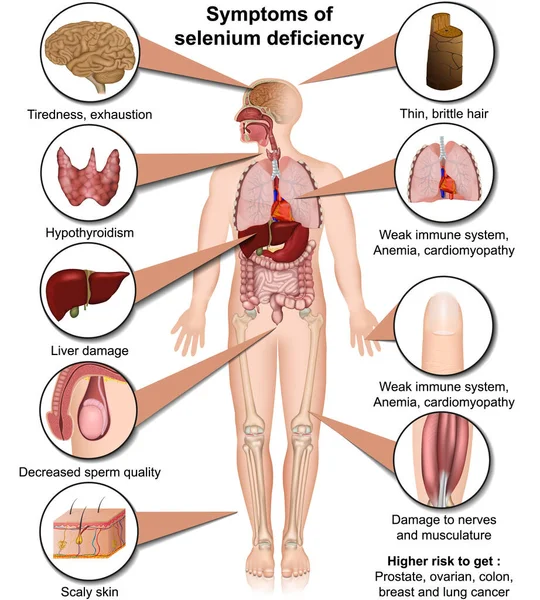 Ilustración Del Vector Médico Deficiencia Selenio Aislado Infografía Fondo Blanco — Vector de stock