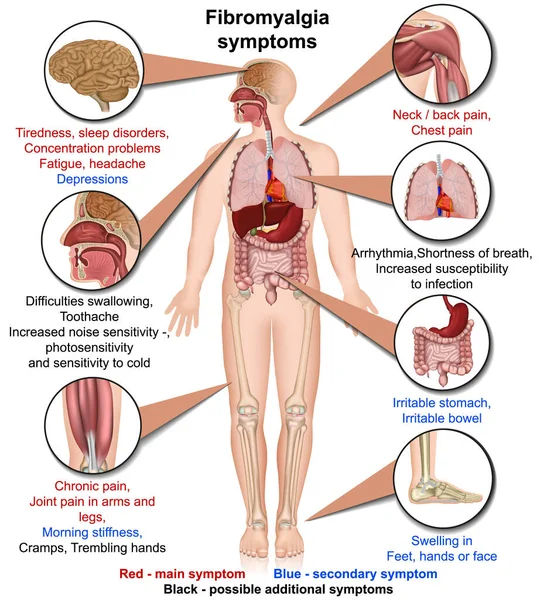 Fibromyalgia Symptoms Medical Vector Illustration Isolated White Background Infographic — Stock Vector
