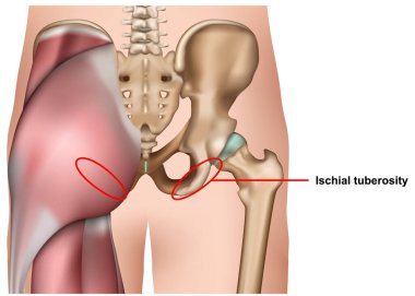iskiyal tüberkülozluk beyaz arkaplan bilgisinde izole edilmiş 3d tıbbi vektör çizimi