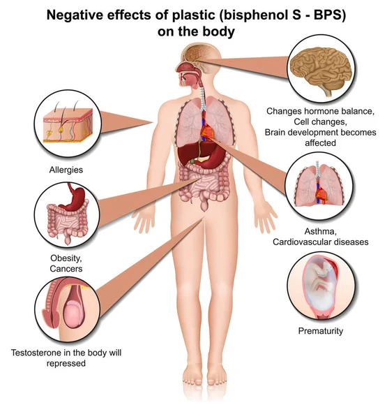 Wpływ Bisfenolu Organizm Człowieka Ilustracja Wektora Medycznego Wyizolowana Białym Tle — Wektor stockowy