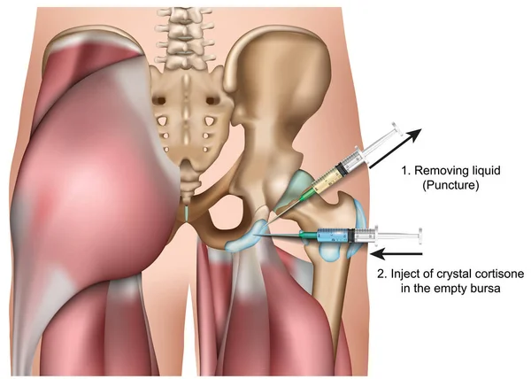 Inyección Bursa Cadera Vector Médico Ilustración Aislada Sobre Fondo Blanco — Vector de stock