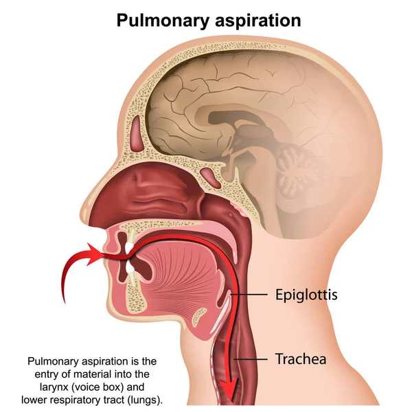 Aspirazione Polmonare Illustrazione Vettoriale Medica Isolato Sfondo Bianco — Vettoriale Stock