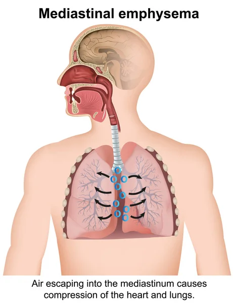 白地に隔離された縦隔肺気腫の医療ベクトル図Eps10 — ストックベクタ