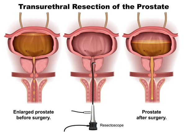 Ressecção Transuretral Ilustração Infográfico Vetorial Médico Com Descrição Inglês — Vetor de Stock