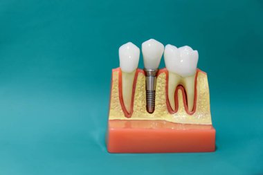 Diş implantı modelinin arkaplanı kopyalama alanı ile yakınlaş