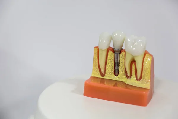 background of dental implant model close up  with copy space