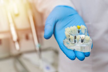 Diş implantı konsepti. Diş hekimi, diş implantı olan bir insan kavanozu modeli tutuyor..