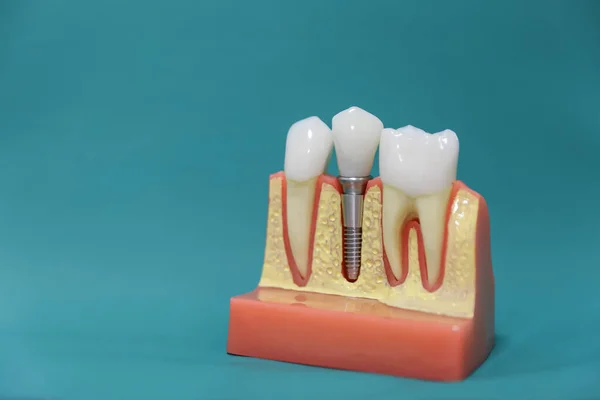 Yeşil arka planda diş implantı modeli
