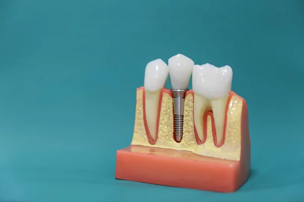 Modelo Implante Dental Sobre Fondo Verde Imágenes De Stock Sin Royalties Gratis