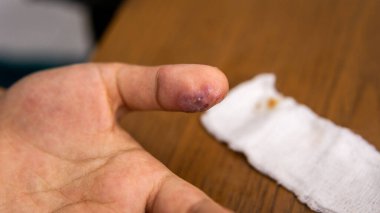 An infection wound with pus inside the thumb on the white bandage with blood stains. Causing from friction to phone touchscreen of playing to many mobile games. clipart