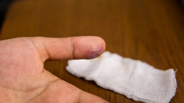 Infection Wound Pus Thumb White Bandage Blood Stains Causing Friction — Stock Photo, Image
