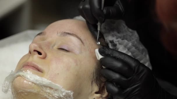 Косметолог робить процедуру очищення обличчя косметологією шкіри акне на обличчі жінки — стокове відео