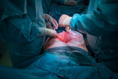 Bir cerrahi ekip cerrahi karın ameliyatı gerçekleştirir.