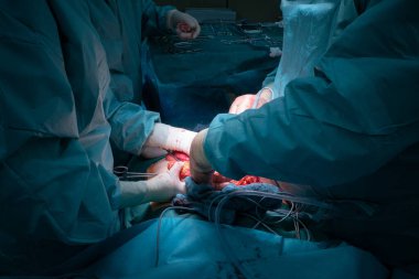 Bir cerrahi ekip cerrahi karın ameliyatı gerçekleştirir.