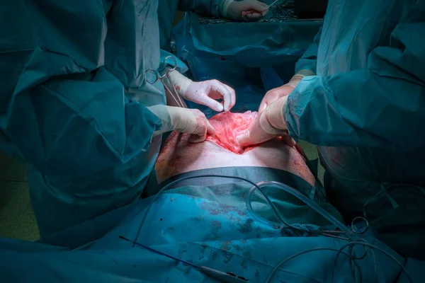 Ett Kirurgiskt Team Utför Operation Buken — Stockfoto