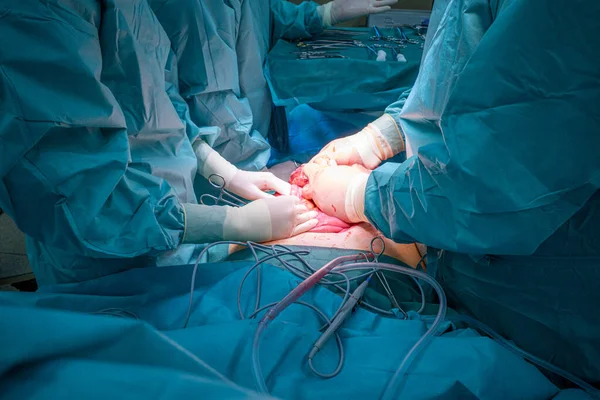Хірургічна Команда Виконує Хірургічну Операцію Животі — стокове фото