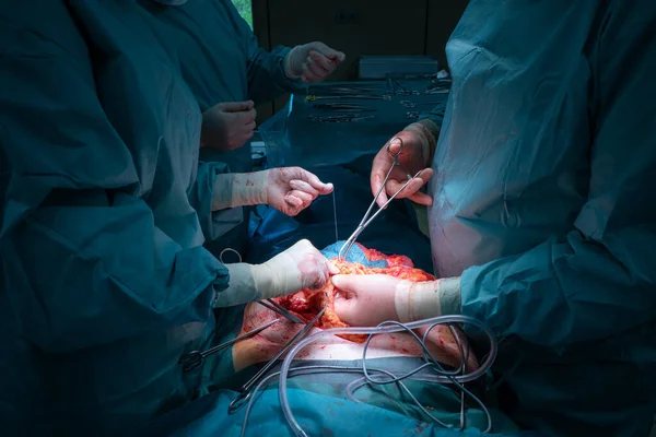 Bir Cerrahi Ekip Cerrahi Karın Ameliyatı Gerçekleştirir — Stok fotoğraf