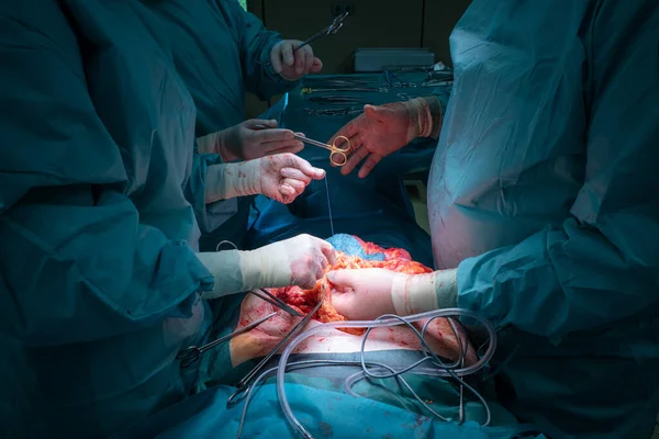 Uma Equipe Cirúrgica Realiza Uma Operação Abdominal Cirúrgica — Fotografia de Stock