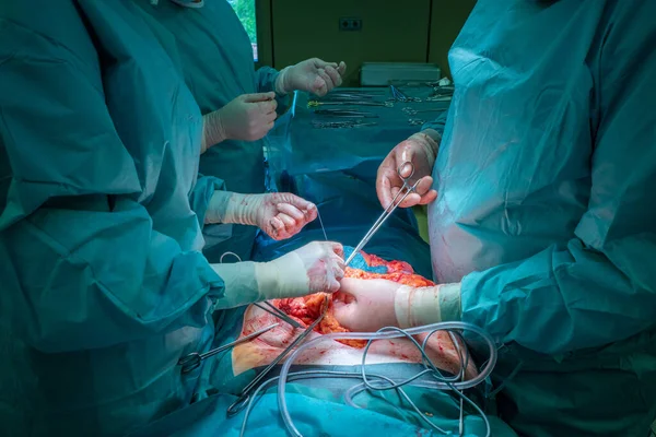 Ett Kirurgiskt Team Utför Operation Buken — Stockfoto