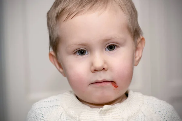 Herpes on upper lip of a little girl. Wound on the face of a schoolboy. Inflammation of the lip. Child with cold sores on her lip. Beautiful lips infected herpes virus