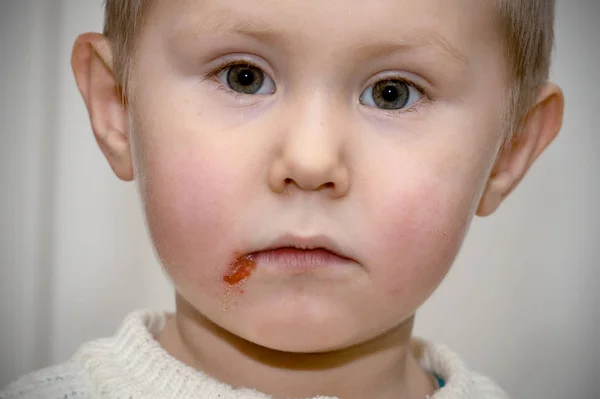 Herpes on upper lip of a little girl. Wound on the face of a schoolboy. Inflammation of the lip. Child with cold sores on her lip. Beautiful lips infected herpes virus