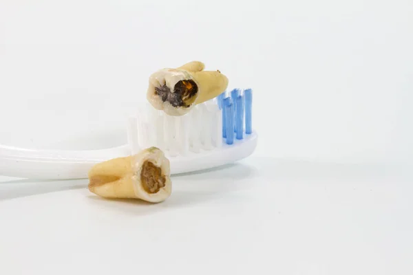 La carie dentaire carie dentaire et brosse à dents — Photo