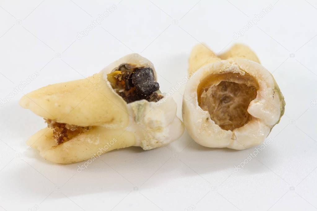 decayed tooth on white background