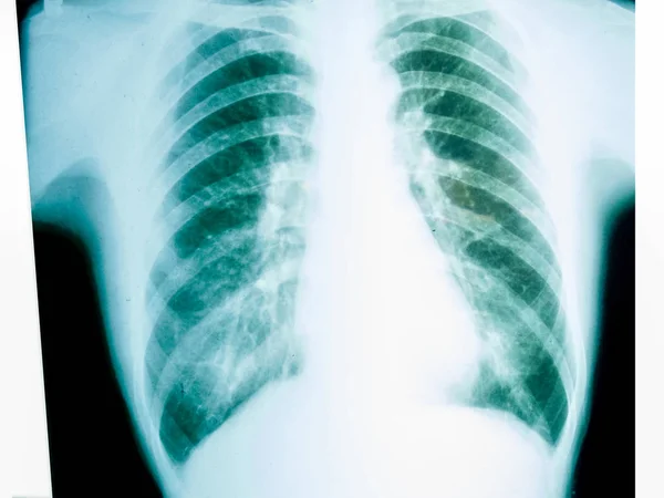 Chest X-ray — Stock Photo, Image