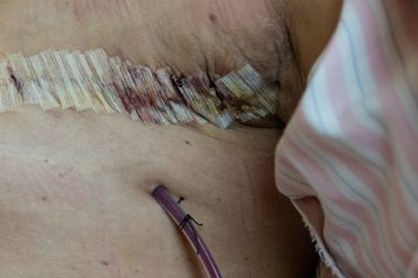 Ameliyat sonrası cerrahi drenaj ve kadındaki dikiş