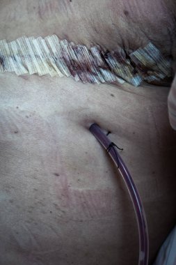 Ameliyat sonrası cerrahi drenaj ve kadındaki dikiş