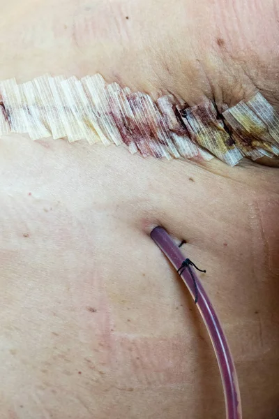 Dreno cirúrgico e sutura na mulher pós-cirurgia — Fotografia de Stock