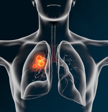 Lung cancer or bronchial carcinoma of a man, 3D medically illust clipart