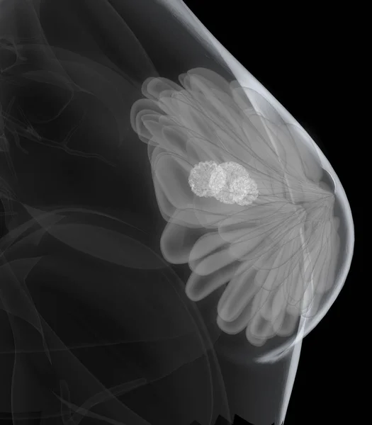 Mammography, breast cancer screening, 3D illustration