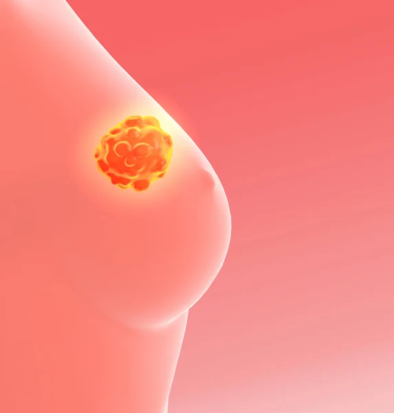 Göğüs kanseri, tıbbi olarak 3 boyutlu illüstrasyon — Stok fotoğraf