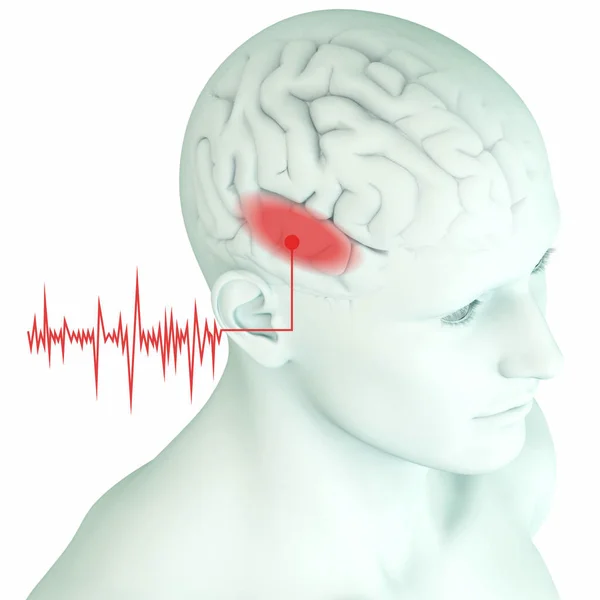 Tinnitus, onda sonora roja y corteza auditiva marcada, médicamente 3D —  Fotos de Stock
