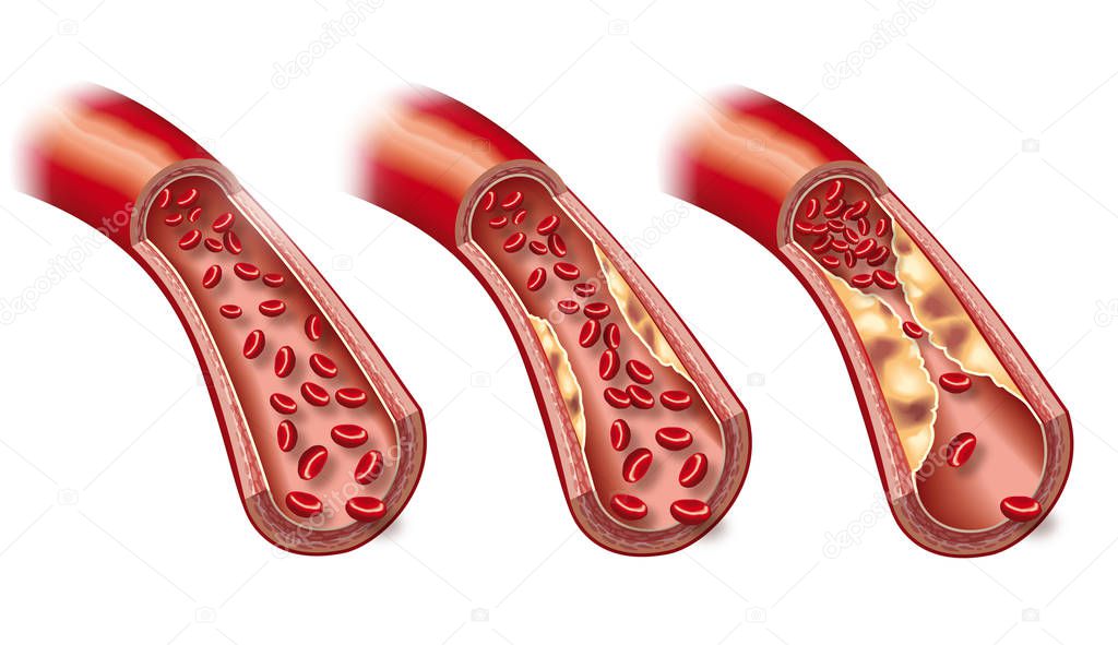 Blood stream in healthy artery and beginning arteriosclerosis, 3